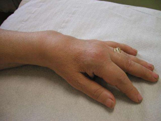 Artrite reumatoideIl biologico funziona