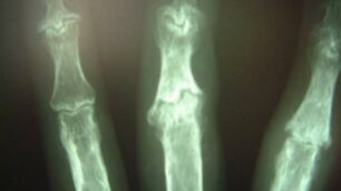 Artrosi e osteoporosi Visite gratuite