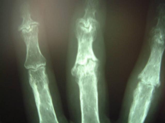 Artrosi e osteoporosi Visite gratuite