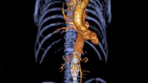 Aorta e aneurismaNuove soluzioni