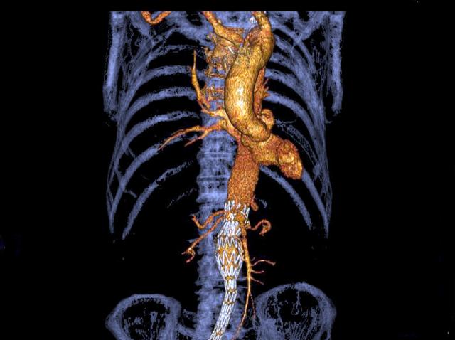 Aorta e aneurismaNuove soluzioni