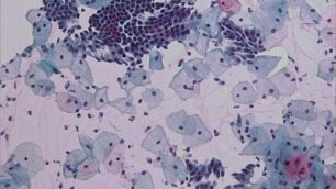 Pap test ancheper utero e ovaie