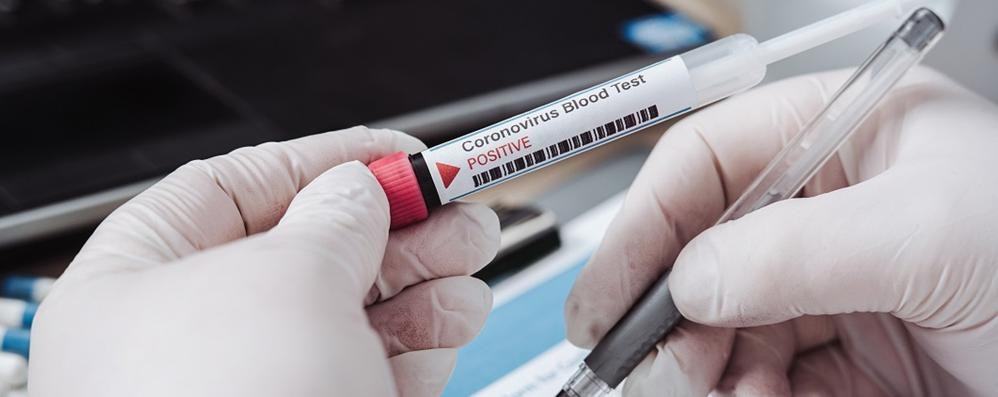 Coronavirus test sierologici