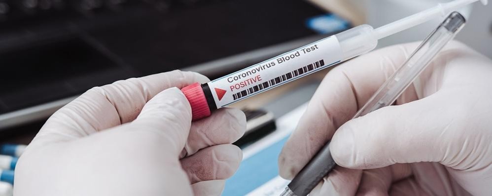 Coronavirus test sierologici