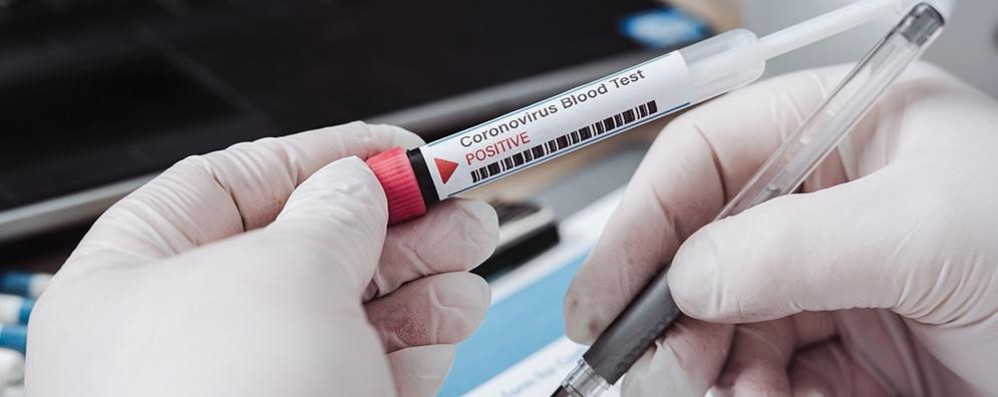 Coronavirus test sierologici