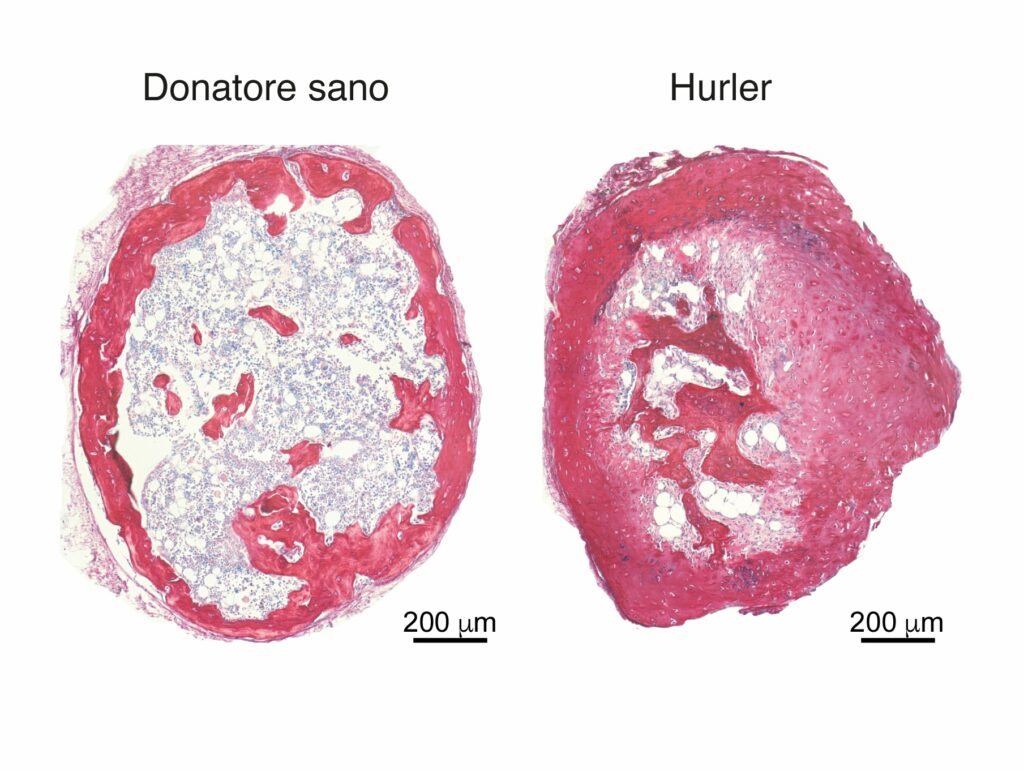 Grafica che illustra l’organoide di osso ottenuto da cellule derivate da donatori sani e da pazienti con sindrome di Hurler