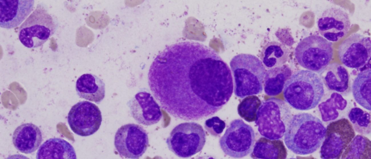 Leucemia mieloide cronica