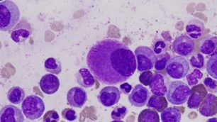 Leucemia mieloide cronica